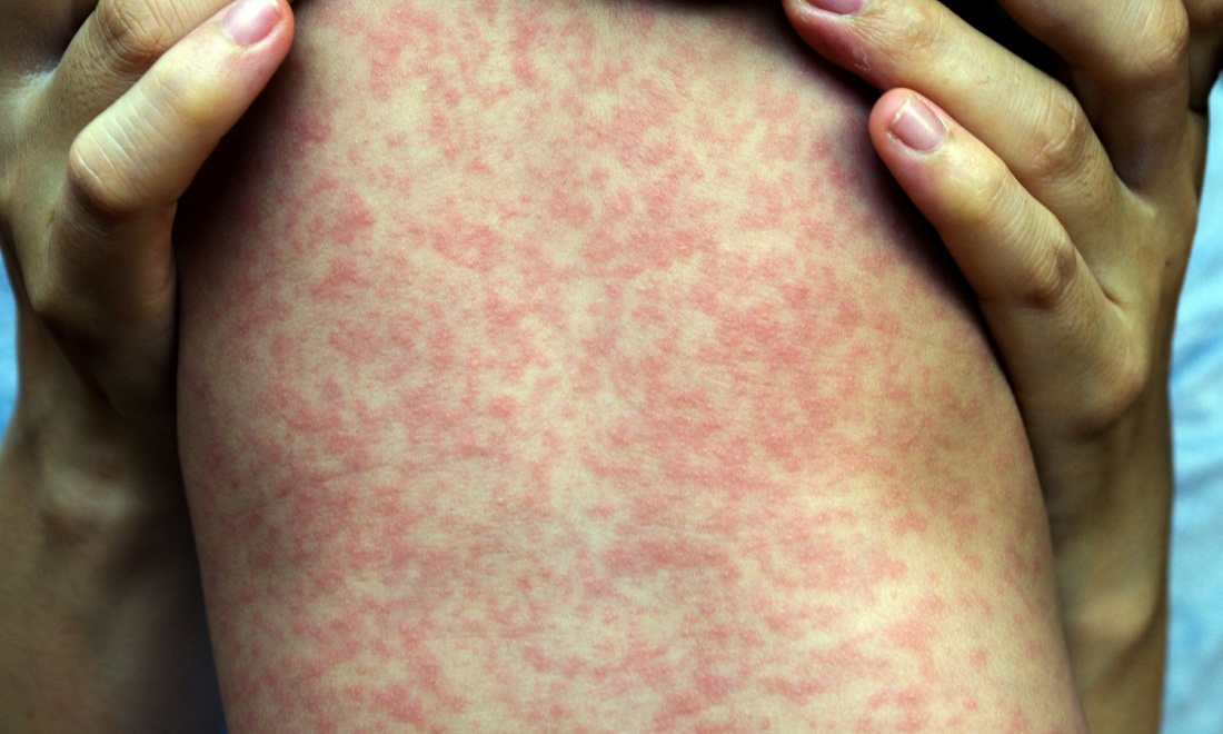 Measles outbreak in Eindhoven